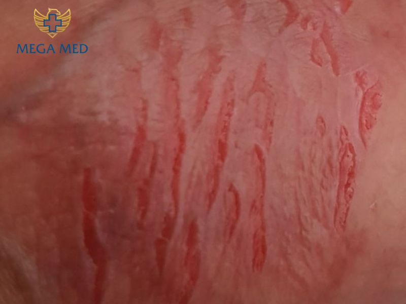 quy đầu sưng sau khi lột bao quy đầu